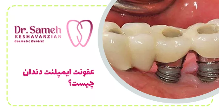 عفونت ایمپلنت دندان چیست؟
