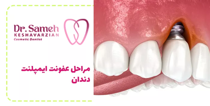 مراحل عفونت ایمپلنت دندان