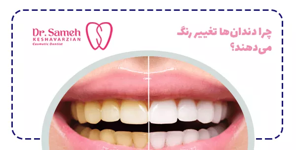 چرا دندان‌ها تغییر رنگ می‌دهند؟
