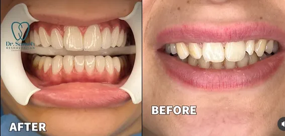 عکس نمونه لمینت دندان عکس نمونه لمینت دندان