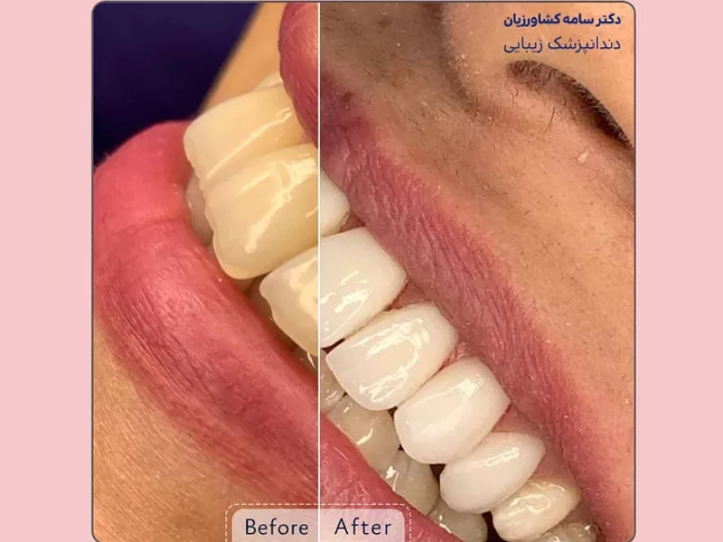 لمینت دندان