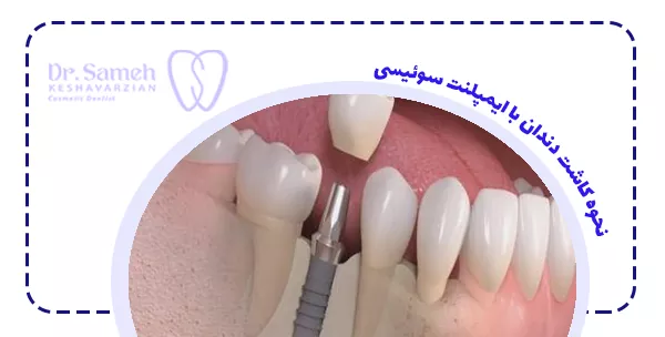 نحوه کاشت دندان با ایمپلنت سوئیسی