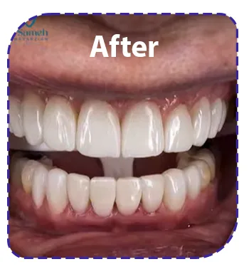 نمونه عکس بعداز کامپوزیت دندان نمونه عکس بعداز کامپوزیت دندان