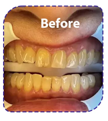 نمونه عکس قبل از کامپوزیت دندان نمونه عکس قبل از کامپوزیت دندان