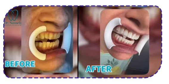 نمونه کار کامپوزیت دندان نمونه کار کامپوزیت دندان