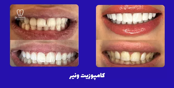 نمونه کار کامپوزیت دندان