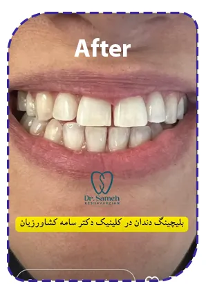 بعد از بلیچینگ دندان بعد از بلیچینگ دندان