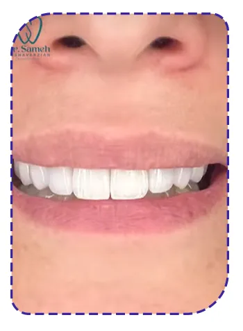بعد از لمینت دندان بعد از لمینت دندان