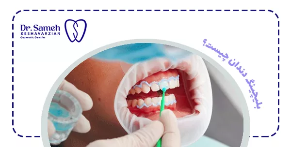 بلیچینگ دندان چیست؟