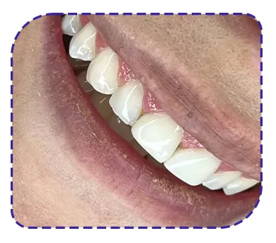 بلیچینگ و کامپوزیت دندان بلیچینگ و کامپوزیت دندان