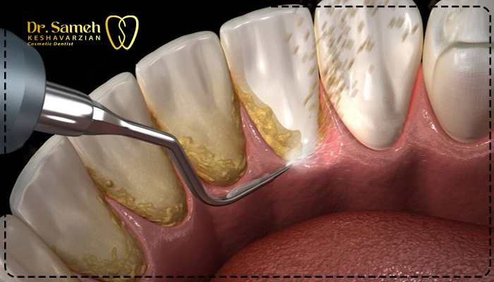 جرم گیری دندان درد دارد