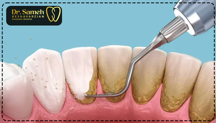 جرم گیری دندان چقدر طول میکشه