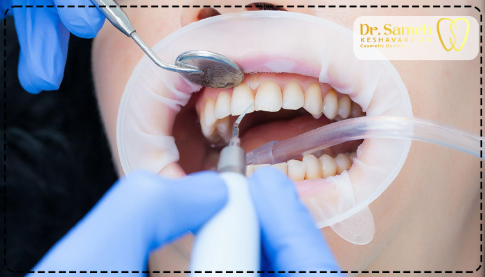 جرمگیری دندان