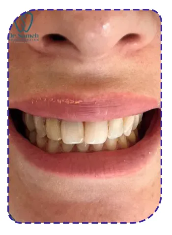 قبل از لمینت دندان قبل از لمینت دندان