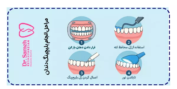 مراحل انجام بلیچینگ دندان مراحل انجام بلیچینگ دندان