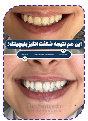 نتیجه بلیچینگ دندان نتیجه بلیچینگ دندان