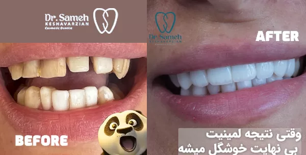 قبل و بعد از لمینت دندان توسط دکتر کشاورزیان قبل و بعد از لمینت دندان توسط دکتر کشاورزیان