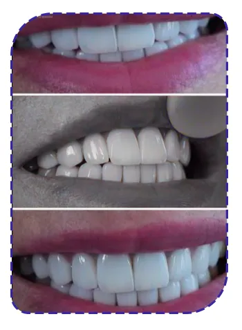 هزینه لمینت دندان هزینه لمینت دندان