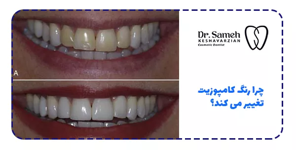 چرا رنگ کامپوزیت تغییر می کند؟