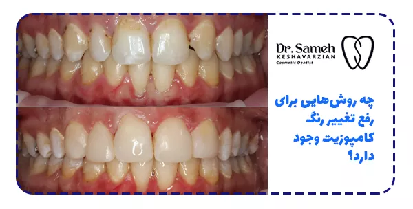 چه روش‌هایی برای رفع تغییر رنگ کامپوزیت وجود دارد؟