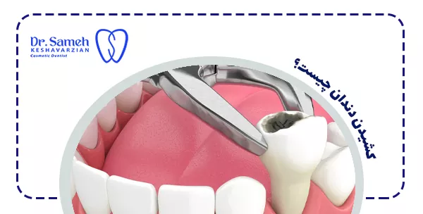 کشیدن دندان چیست؟