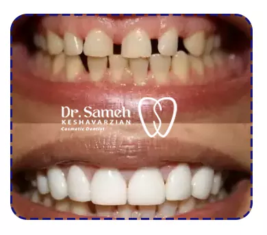 عکس نمونه کار لمینت دندان