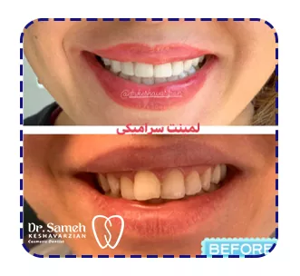 نمونه قبل و بعد لمینت سرامیکی دندان