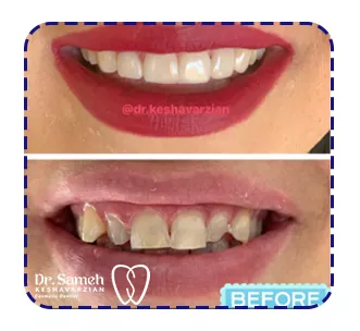 نمونه قبل و بعد کامپوزیت دندان نمونه قبل و بعد کامپوزیت دندان