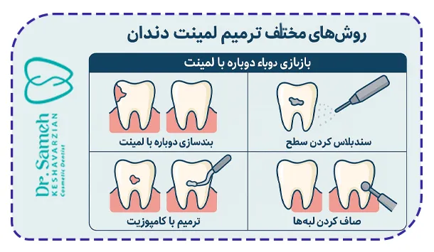 روش‌های مختلف ترمیم لمینت دندان