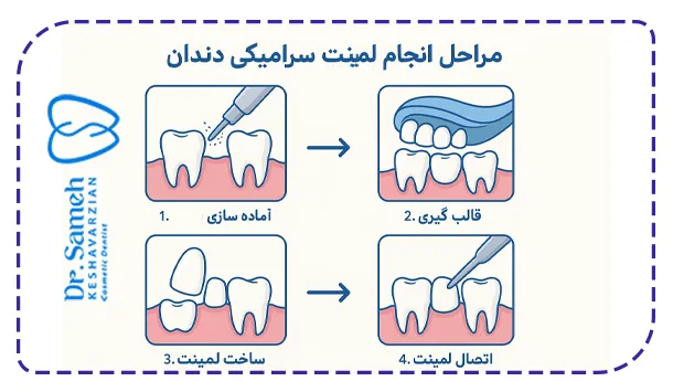 مراحل لمینت سرامیکی دندان
