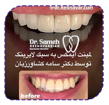 نمونه کار لمینت لایرینگ دندان