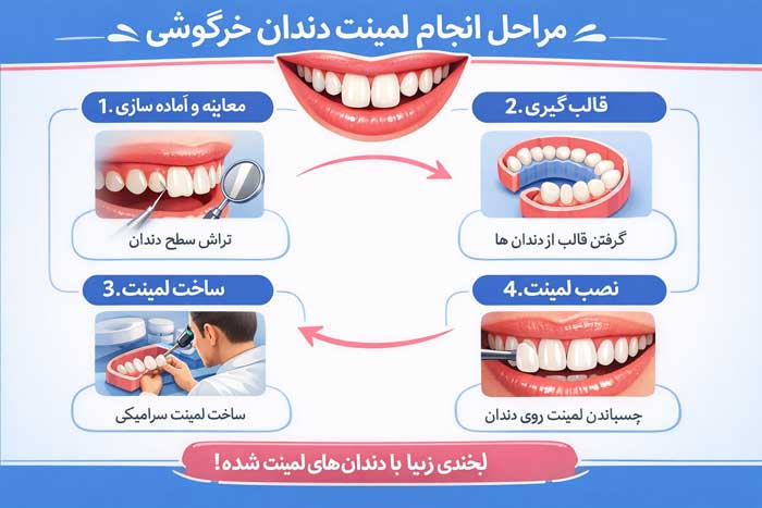 مراحل لمینت دندان خرگوشی
